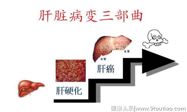 肝癌"祸根"已找到，医生：常吃3种食物的人，最好去查一下肝CT