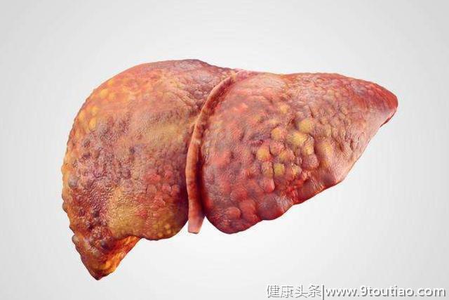 肝癌"祸根"已找到，医生：常吃3种食物的人，最好去查一下肝CT