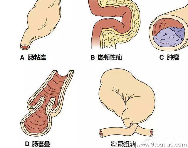 45岁男子，查出肠癌晚期，提醒：排便出现4种症状，尽早就医！