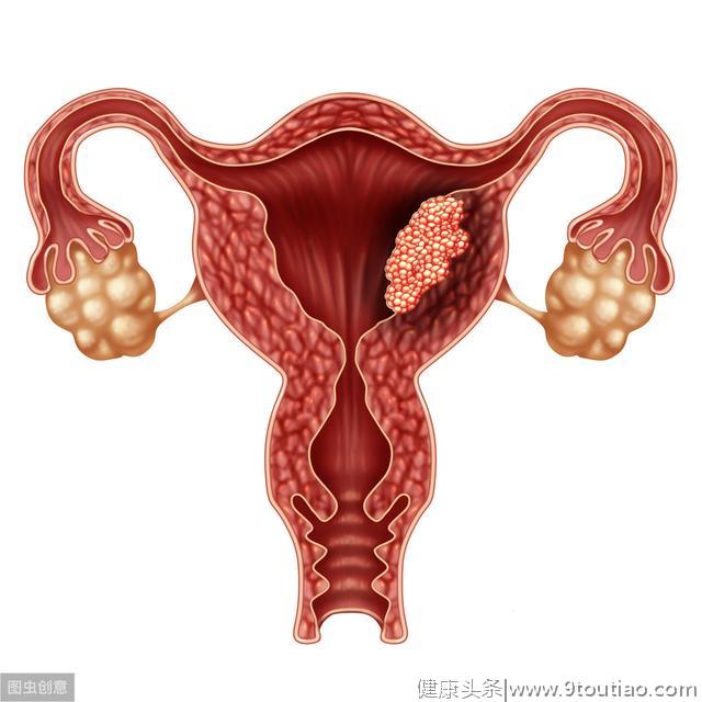 子宫内膜增生、病变，如果你是这类女性，尽可能拿掉子宫！