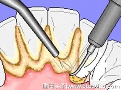 牙齿发黄笑容尴尬，牙齿发黄是什么原因造成的