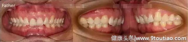 很多人都有！牙齿的深覆合需要重视-济宁丁香树口腔