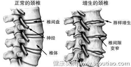 常见的颈椎病该怎么调护？送你一套简单实用的颈椎操