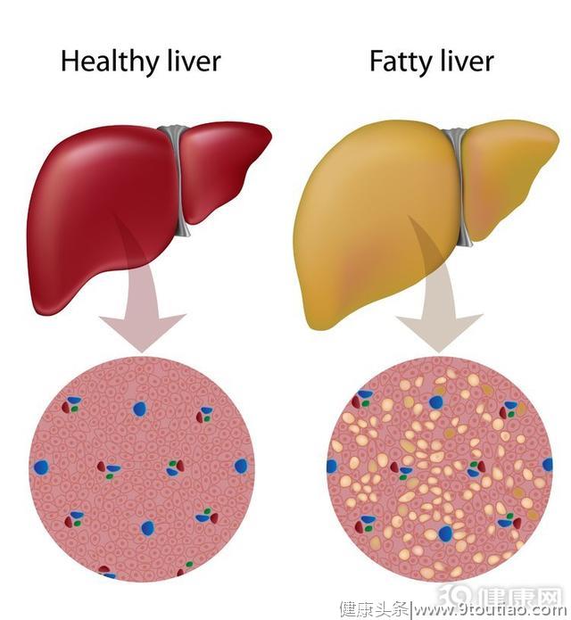 想消除脂肪肝，三个办法很实用，坚持做，肝病不找你