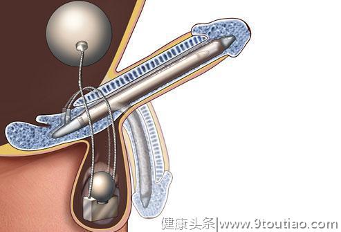 涨姿势！男性勃起障碍很可怕？听过用松紧带和真空泵