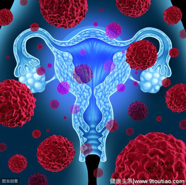 6种人患子宫内膜癌风险大，要一年查一次