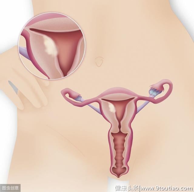 6种人患子宫内膜癌风险大，要一年查一次