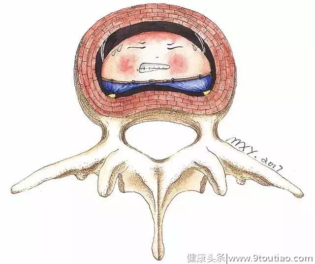 医学小说：悲伤离去的腰间盘