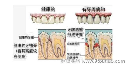 以为选对象才挑人，没想到牙周疾病竟然也“挑人”