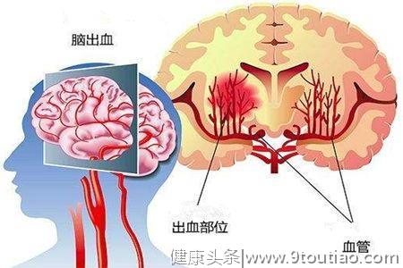 62岁王大爷因高血压引发脑出血，医生提醒：这4种情况应及时检查