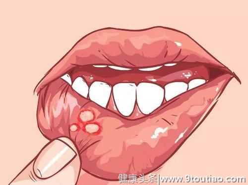 得了口腔溃疡怎么办？口腔溃疡的临床表现有哪些？