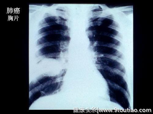 肺癌发病率排第一，怎么样可以确诊肺癌