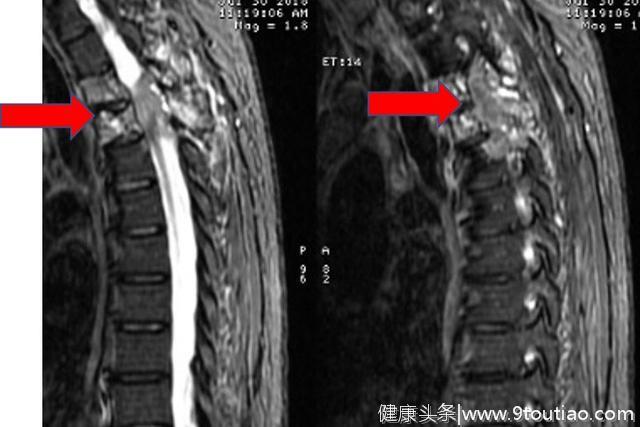 「警惕」癌症患者莫名胸背痛或是癌症在发生转移（成功案例1例）