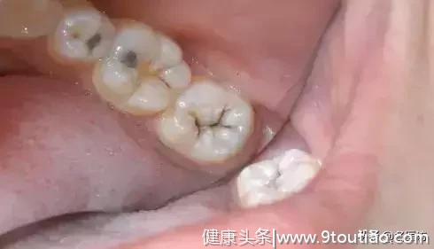 从「浅龋」到「拔牙」，看看牙齿是怎么下岗的？