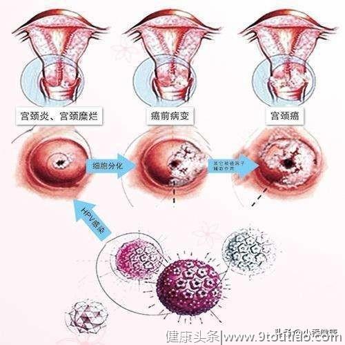 女性长期便秘，应查查宫颈癌，留意早期宫颈癌其他表现