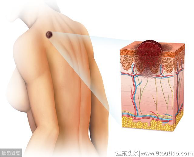 皮肤癌有三种主要症状！医生讲：不要忽视它的危害！