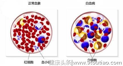 血液科：身体出现哪些症状时，需警惕慢性粒细胞白血病？