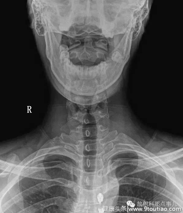颈椎片不适？X光片应该这么读！