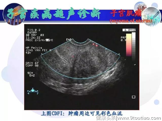 纯干货！子宫及附件解剖和超声诊断