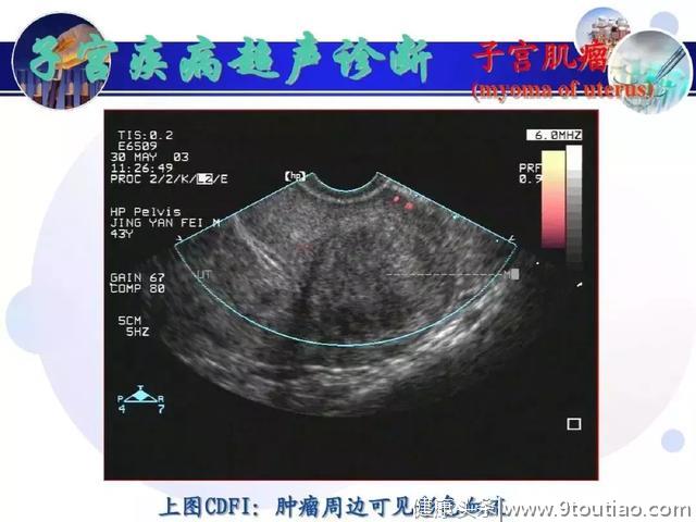 纯干货！子宫及附件解剖和超声诊断