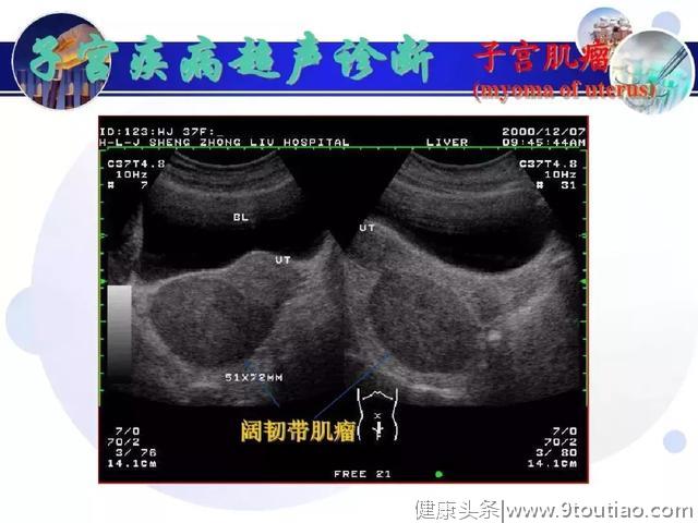 纯干货！子宫及附件解剖和超声诊断