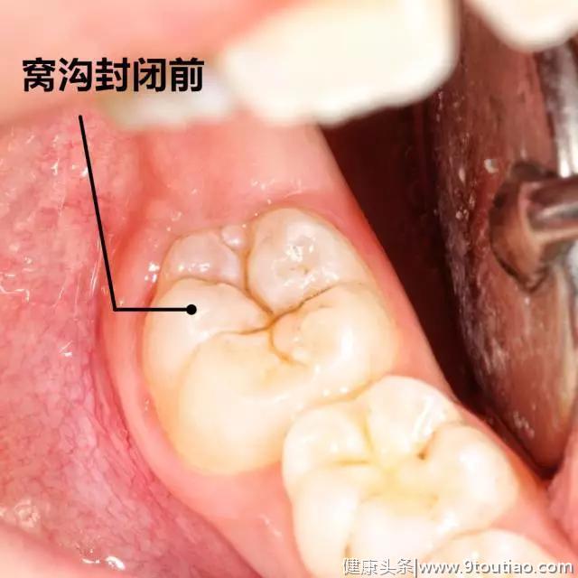 涂氟和窝沟封闭究竟是不是一对CP？