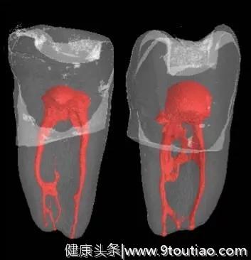 根管治疗是现代牙科诊疗体系的基石