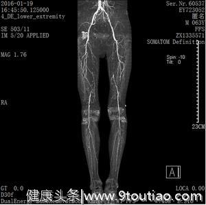 腿疼只是缺钙？专家：腿疼不注意，严重的要截肢！