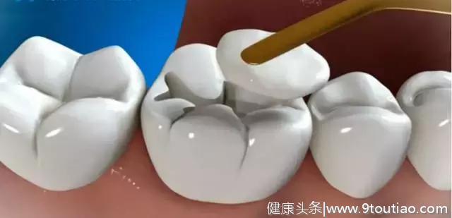 精美图片展示牙医补牙全过程，看完了你就明白了