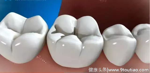 精美图片展示牙医补牙全过程，看完了你就明白了