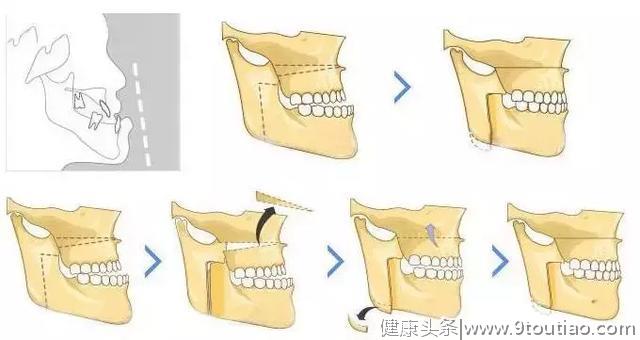 整牙堪比整容？原来，牙齿矫正是这样改变脸型的！济宁丁香树口腔