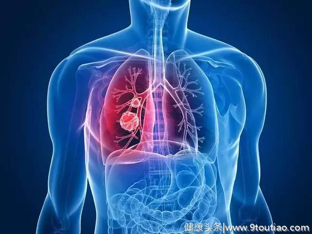 小伙肺癌，病床上等死，肺癌常有4个标志，占2个以上，已到中晚期