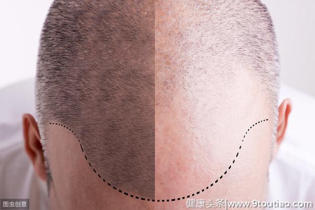 脱发原因男女不一样，这里教你如何预防脱发？