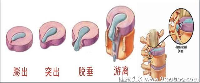 腰痛了，怎么判断是腰间盘突出？