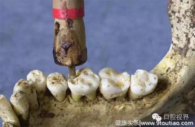 以前牙医是怎样虐待人们牙齿？看完了就知道现在看牙多舒适了！