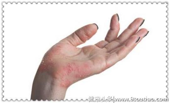 湿疹瘙痒八年，一个小偏方，轻松治愈不复发