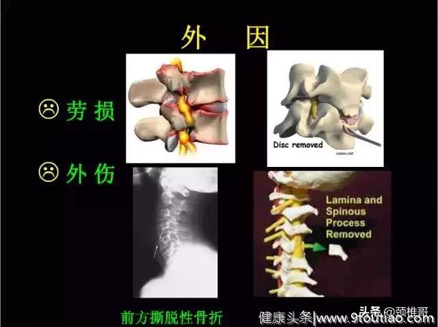 看完这几张图，你就了解了颈椎的结构了