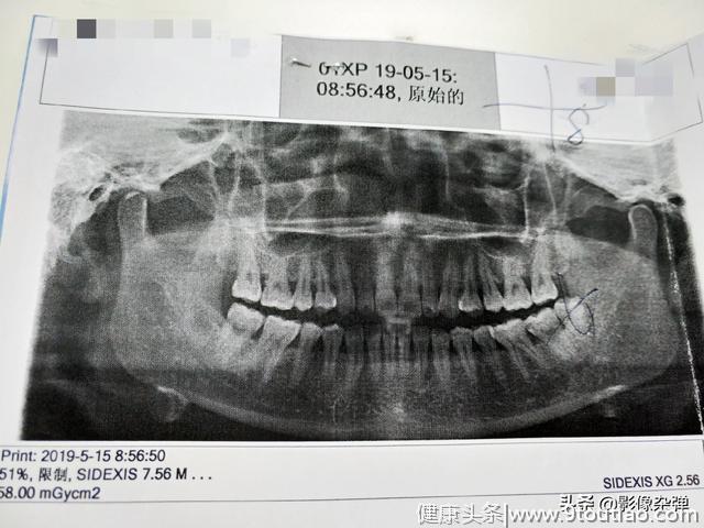 牙科暴利，补牙拔牙贵到让人“心疼”，网友：我要去当牙医