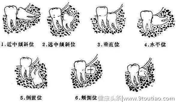 拔了智齿真的可以瘦脸吗？