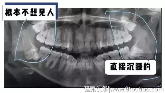 拔了智齿真的可以瘦脸吗？