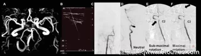 9个病例让你明白颈椎病为何会引起眩晕？