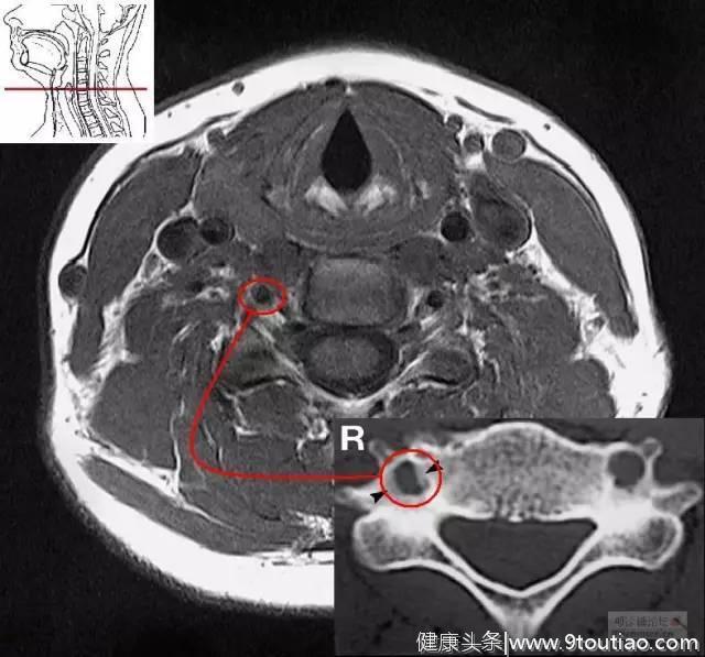 9个病例让你明白颈椎病为何会引起眩晕？