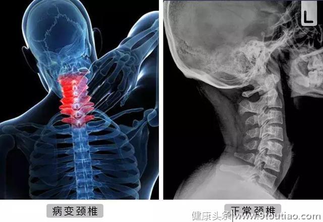 颈椎，正在成为中国人的死穴