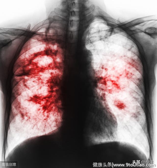 每个肺癌细胞都有恶变基因，中国人常见这两个突变，靶向药效果好