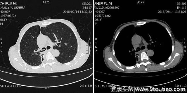 李强教授「呼吸系统疑难、少见病临床诊治浦江论坛」演讲