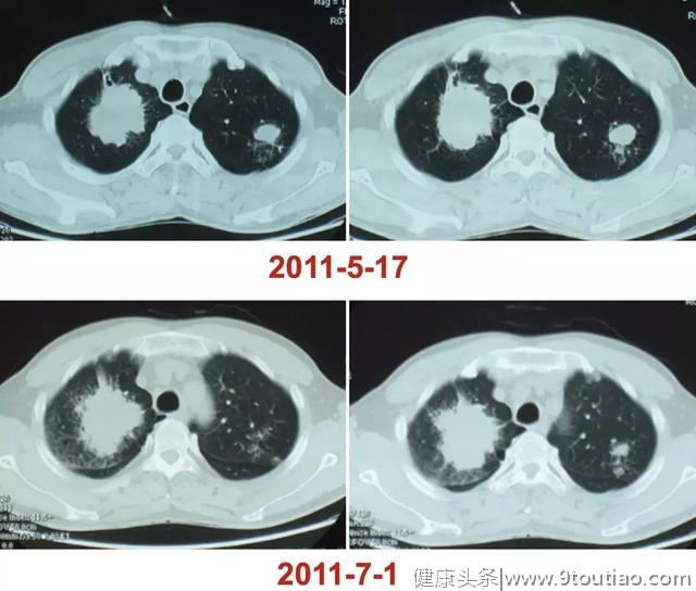 李强教授「呼吸系统疑难、少见病临床诊治浦江论坛」演讲