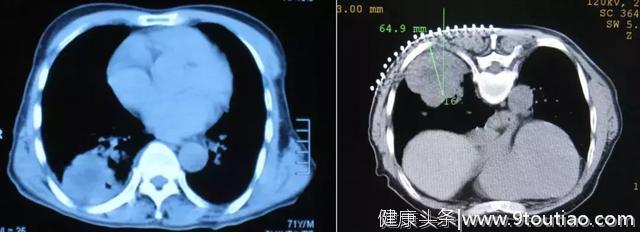 李强教授「呼吸系统疑难、少见病临床诊治浦江论坛」演讲