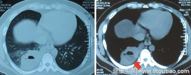 李强教授「呼吸系统疑难、少见病临床诊治浦江论坛」演讲