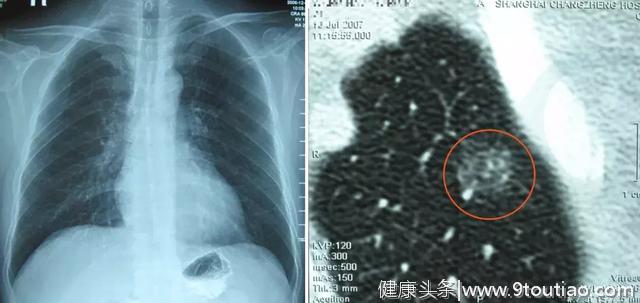 李强教授「呼吸系统疑难、少见病临床诊治浦江论坛」演讲