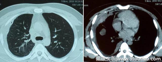 李强教授「呼吸系统疑难、少见病临床诊治浦江论坛」演讲